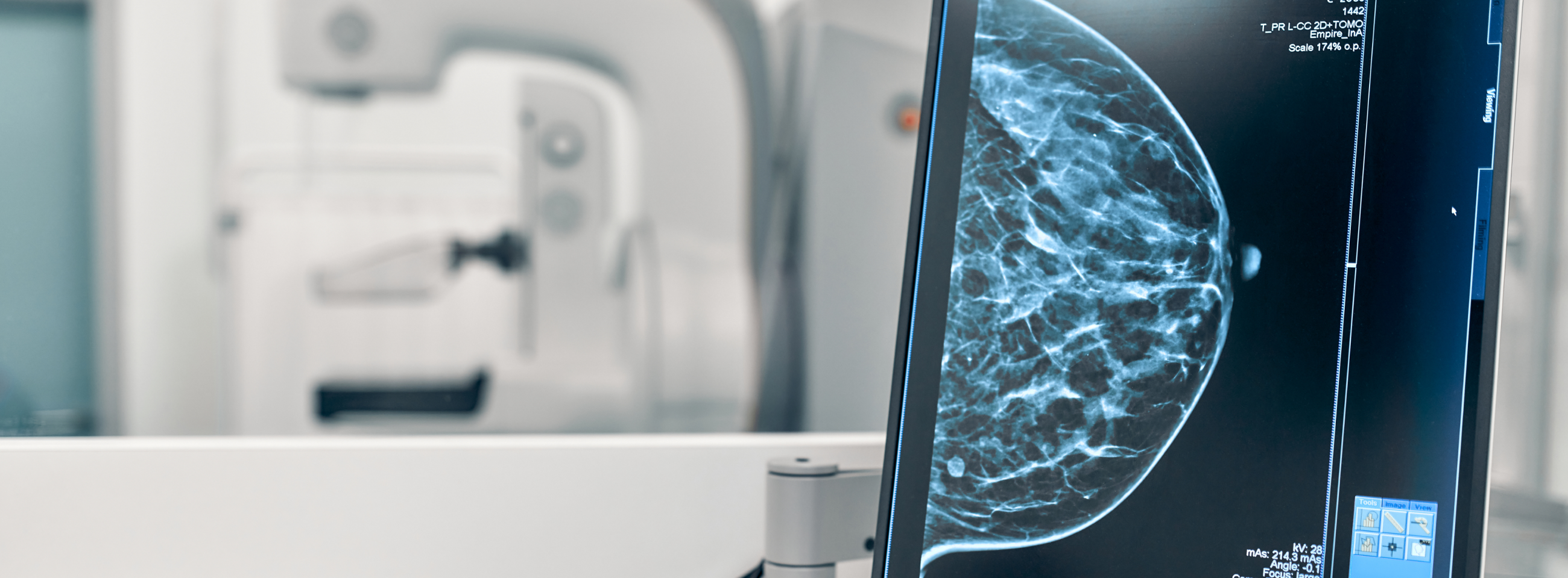 Մամոգրաֆիա